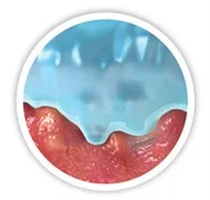 Kreslenie mikrokontúr na lôžko rany