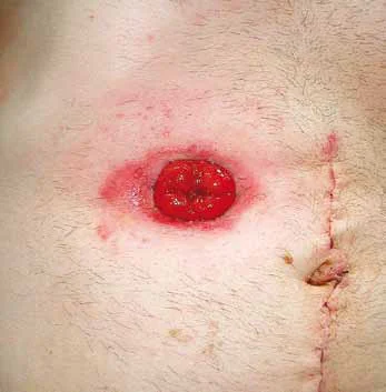 Powikłania skórne stomii