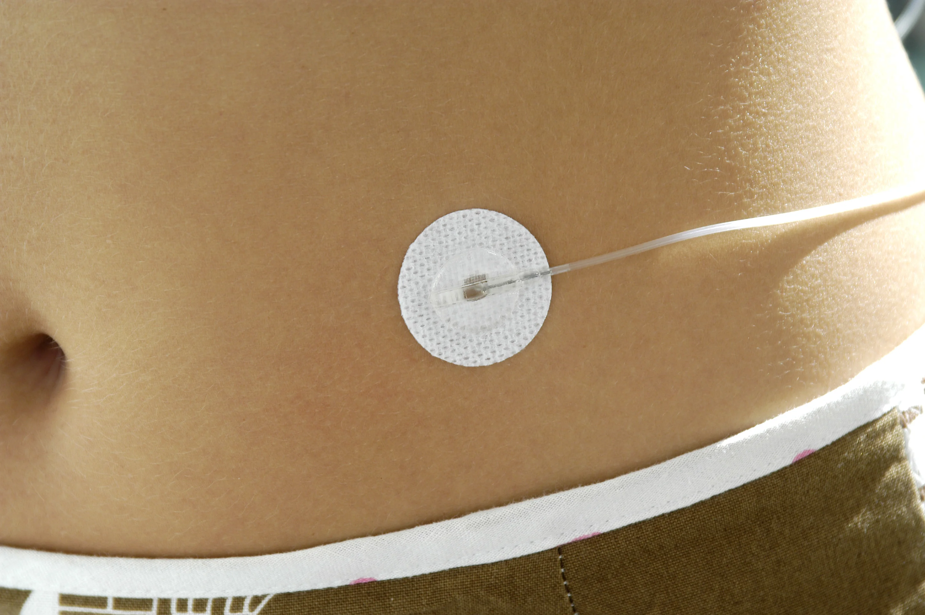 Neria infusion set on the body
